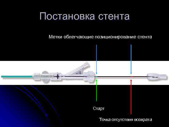 Постановка стента Метки облегчающие позиционирование стента    Старт    Точка