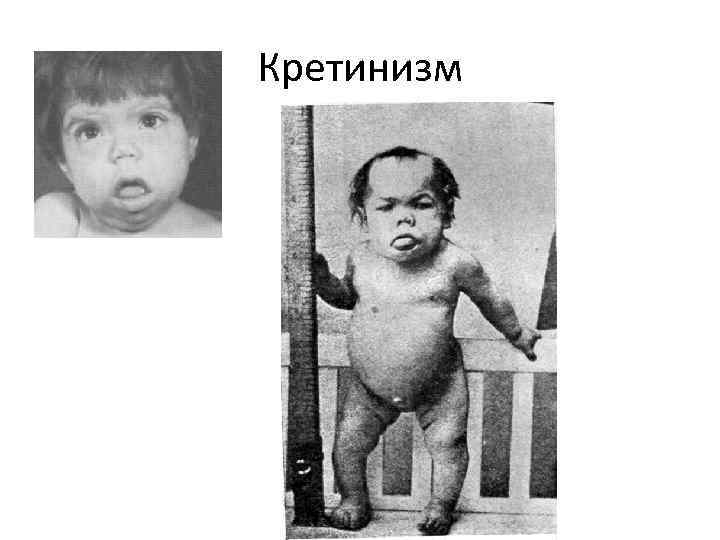 Кретинизм 