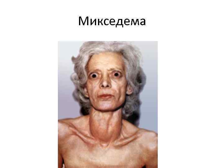 Микседема 