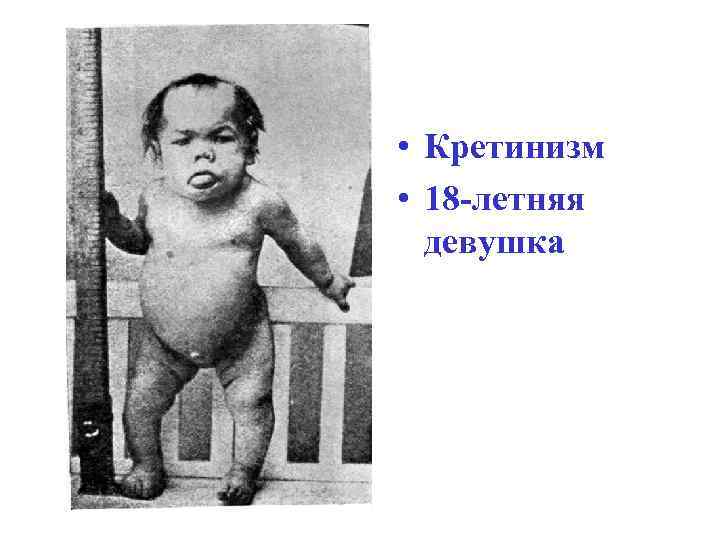  • Кретинизм • 18 -летняя  девушка 