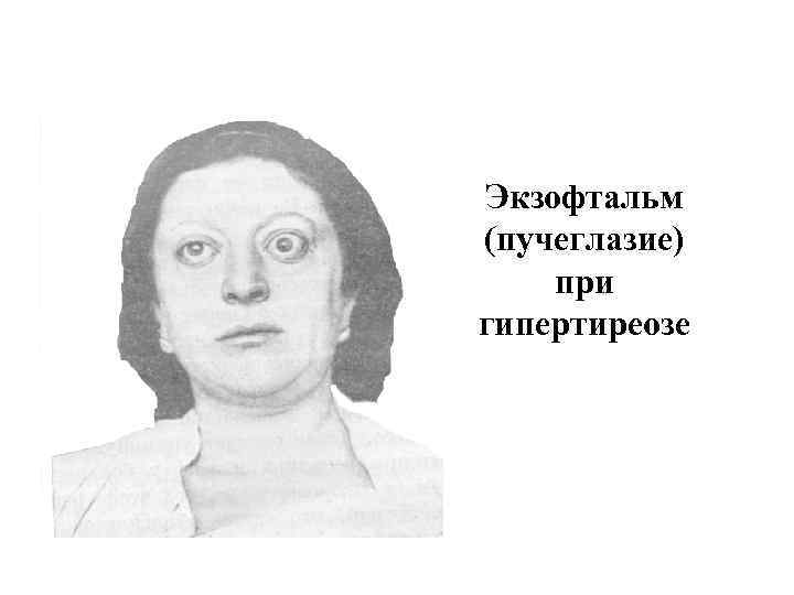 Экзофтальм (пучеглазие) при гипертиреозе 