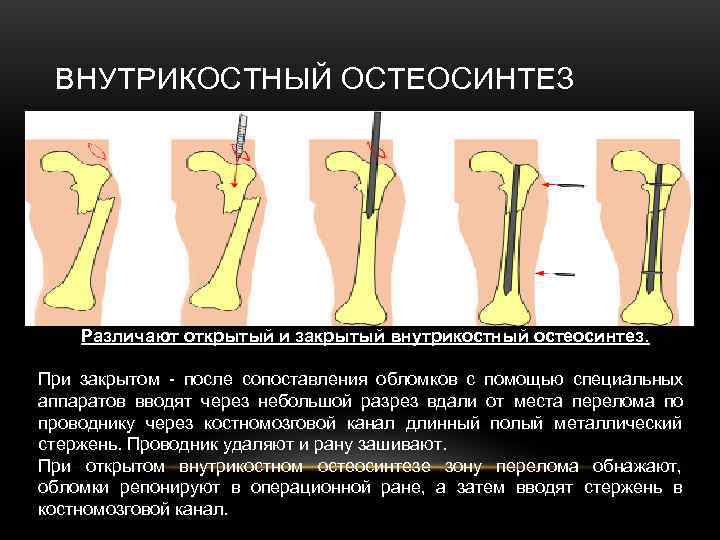 ВНУТРИКОСТНЫЙ ОСТЕОСИНТЕЗ Различают открытый и закрытый внутрикостный остеосинтез. При закрытом ВНУТРИКОСТНЫЙ ОСТЕОСИНТЕЗ Различают открытый и закрытый внутрикостный остеосинтез. При закрытом