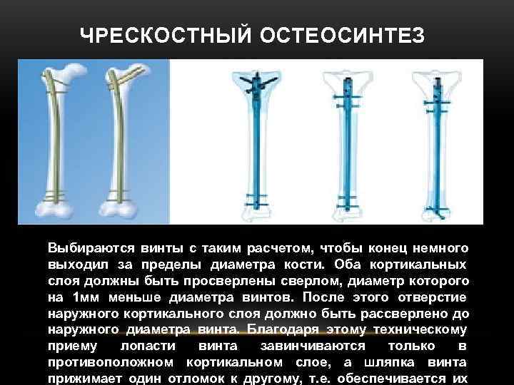 ЧРЕСКОСТНЫЙ ОСТЕОСИНТЕЗ Выбираются винты с таким расчетом, чтобы конец немного выходил ЧРЕСКОСТНЫЙ ОСТЕОСИНТЕЗ Выбираются винты с таким расчетом, чтобы конец немного выходил