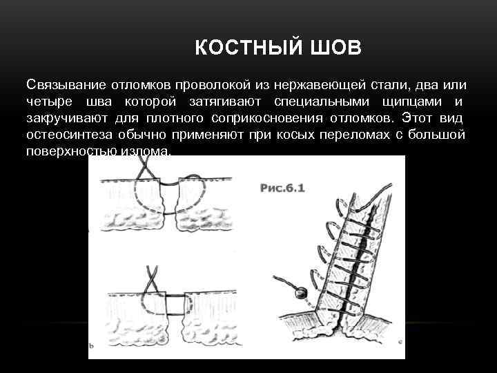 КОСТНЫЙ ШОВ Связывание отломков проволокой из нержавеющей стали, два КОСТНЫЙ ШОВ Связывание отломков проволокой из нержавеющей стали, два