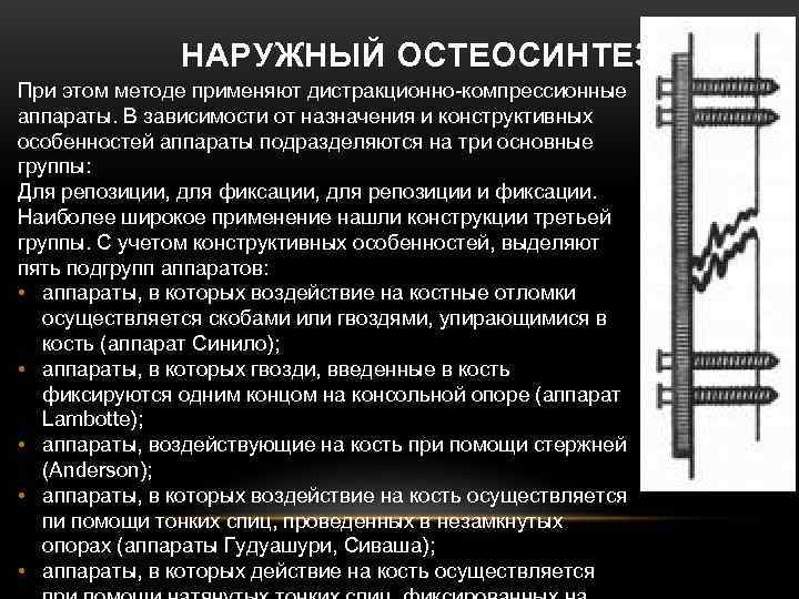 НАРУЖНЫЙ ОСТЕОСИНТЕЗ При этом методе применяют дистракционно компрессионные аппараты. В НАРУЖНЫЙ ОСТЕОСИНТЕЗ При этом методе применяют дистракционно компрессионные аппараты. В