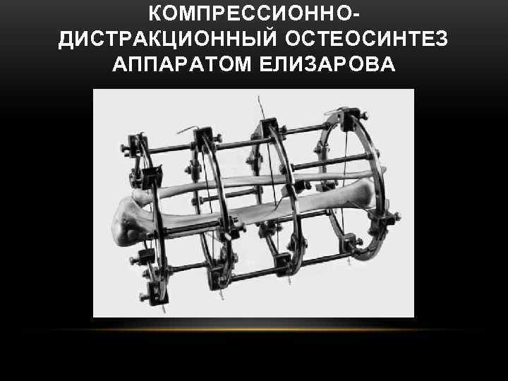 КОМПРЕССИОННО- ДИСТРАКЦИОННЫЙ ОСТЕОСИНТЕЗ АППАРАТОМ ЕЛИЗАРОВА КОМПРЕССИОННО- ДИСТРАКЦИОННЫЙ ОСТЕОСИНТЕЗ АППАРАТОМ ЕЛИЗАРОВА