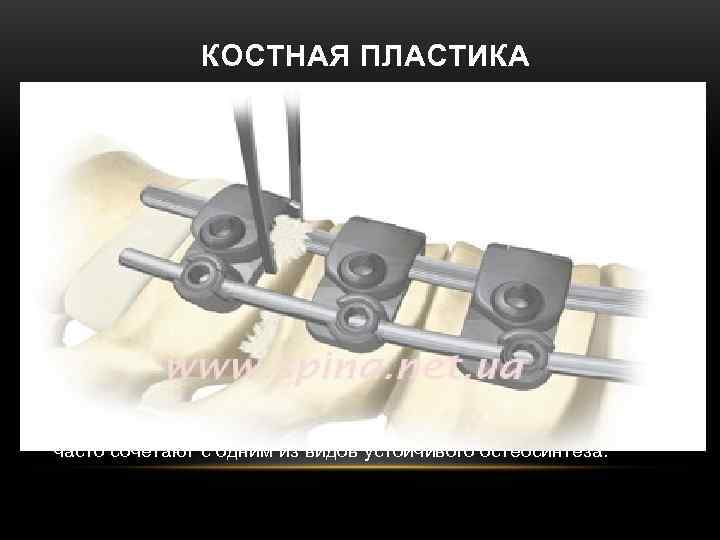 КОСТНАЯ ПЛАСТИКА • Показания к костной пластике: замедленная консолидация КОСТНАЯ ПЛАСТИКА • Показания к костной пластике: замедленная консолидация