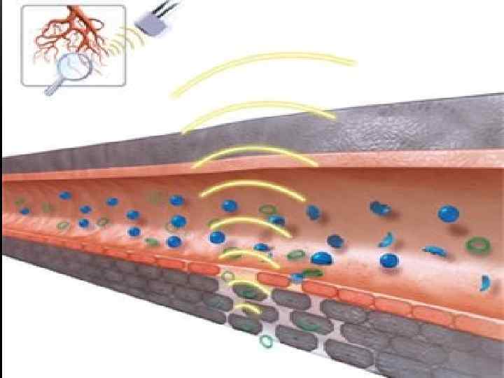 АДГЕЗИВНЫЙ УЛЬТРАЗВУКОВОЙ ОСТЕОСИНТЕЗ • Сущность ультразвуковой сварки костей АДГЕЗИВНЫЙ УЛЬТРАЗВУКОВОЙ ОСТЕОСИНТЕЗ • Сущность ультразвуковой сварки костей