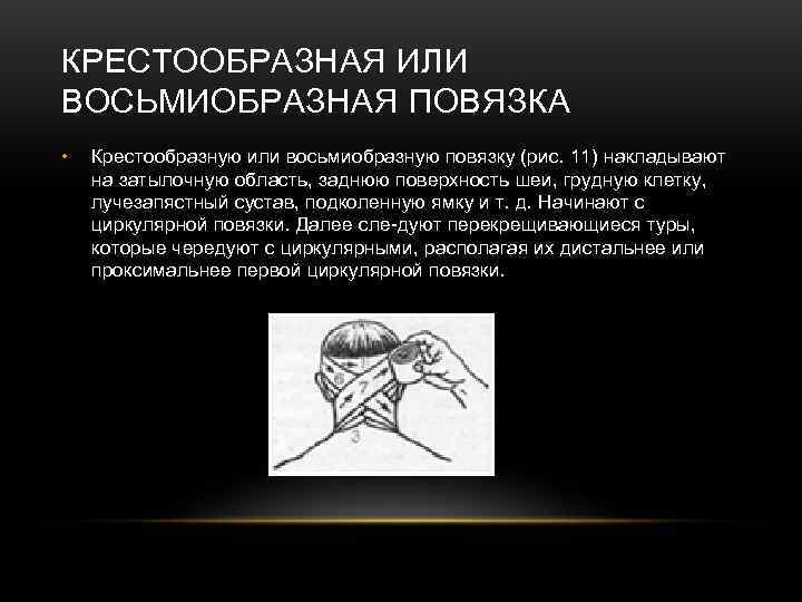 КРЕСТООБРАЗНАЯ ИЛИ ВОСЬМИОБРАЗНАЯ ПОВЯЗКА • Крестообразную или восьмиобразную повязку (рис. 11) накладывают на КРЕСТООБРАЗНАЯ ИЛИ ВОСЬМИОБРАЗНАЯ ПОВЯЗКА • Крестообразную или восьмиобразную повязку (рис. 11) накладывают на