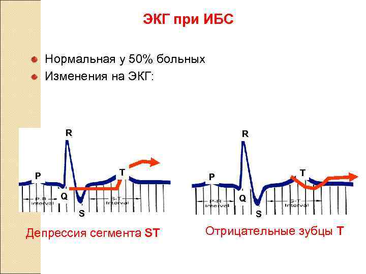 Депрессия st отрицательный