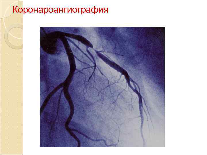Коронароангиография 