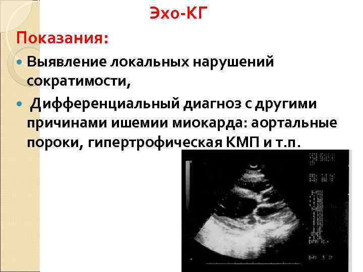     Эхо-КГ Показания:  Выявление локальных нарушений  сократимости,  Дифференциальный