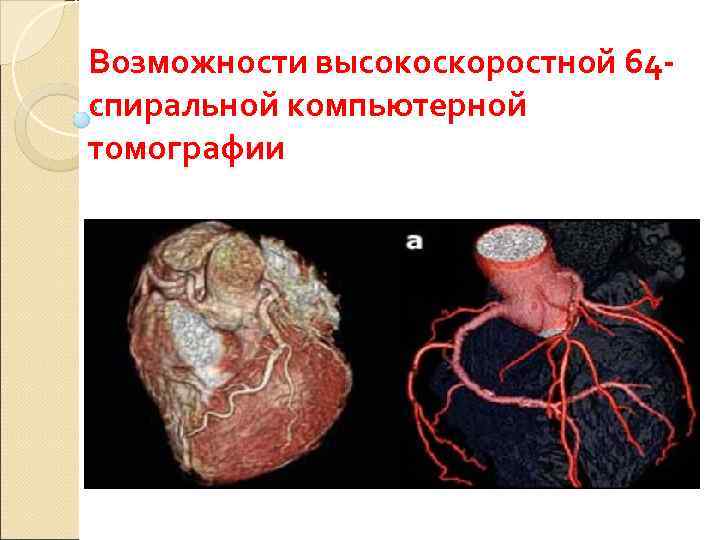 Возможности высокоскоростной 64 - спиральной компьютерной томографии 