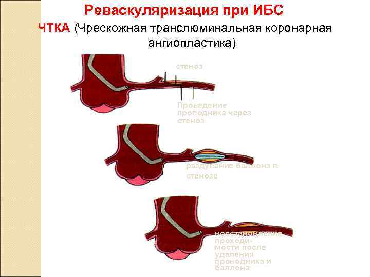  Реваскуляризация при ИБС ЧТКА (Чрескожная транслюминальная коронарная   ангиопластика)   