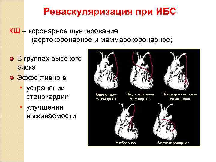    Реваскуляризация при ИБС КШ – коронарное шунтирование  (аортокоронарное и маммарокоронарное)