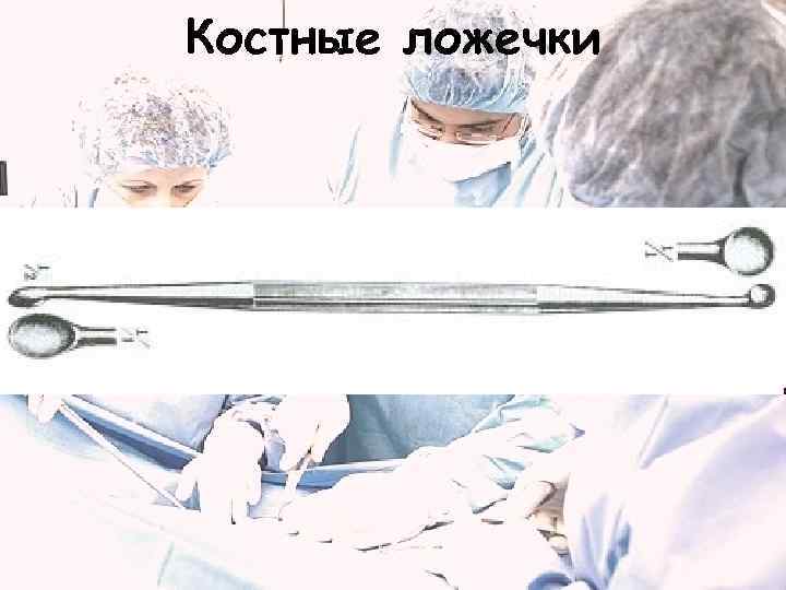 Костные ложечки 