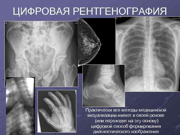 Рентгенография с прямым увеличением изображения применяется