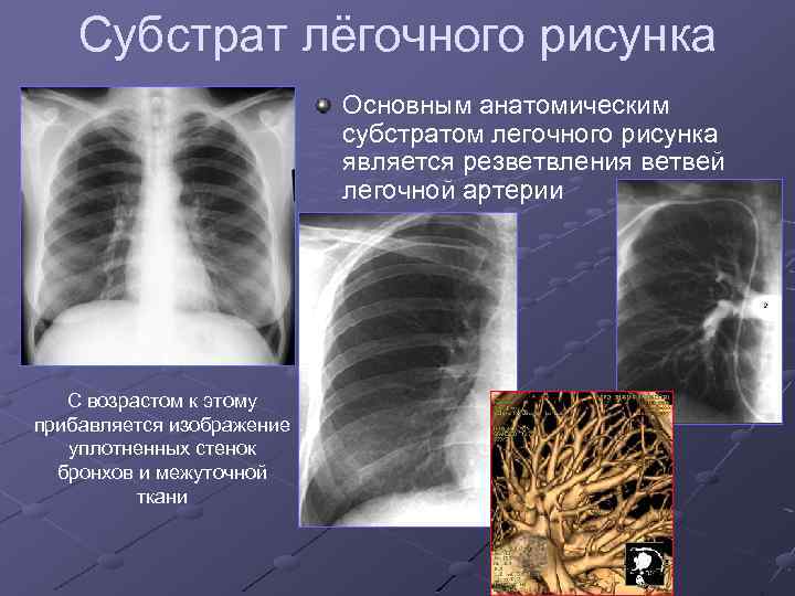 Легочный рисунок это. Анатомический субстрат легочного рисунка. Нормальный легочный рисунок. Легочный рисунок в норме. Нормальный легочный рисунок в рентгеновском изображении.