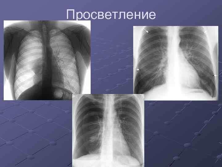 Просветление 