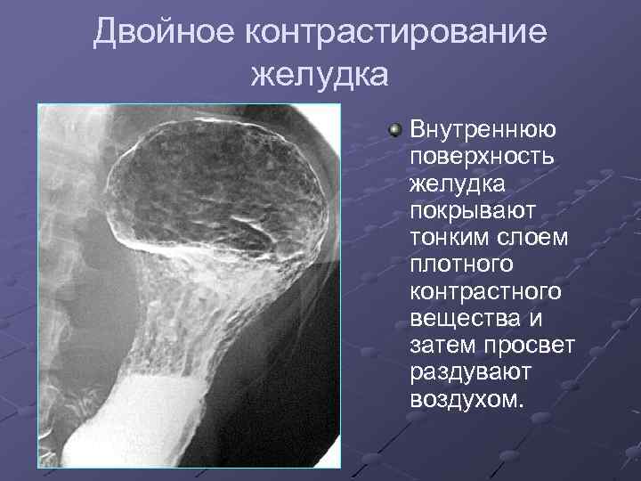 Двойное контрастирование желудка Внутреннюю поверхность желудка покрывают тонким слоем плотного контрастного вещества и затем