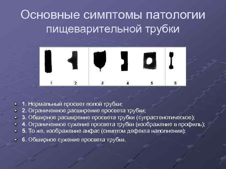 Основные симптомы патологии пищеварительной трубки 1. Нормальный просвет полой трубки; 2. Ограниченное расширение просвета
