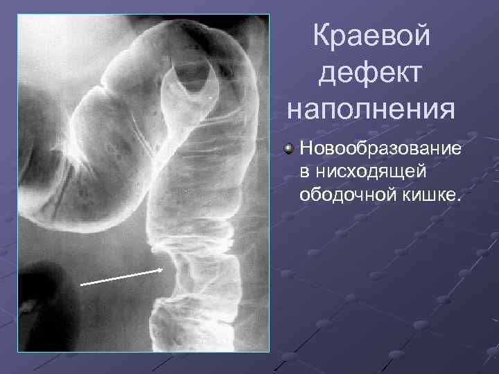 Краевой дефект наполнения Новообразование в нисходящей ободочной кишке. 