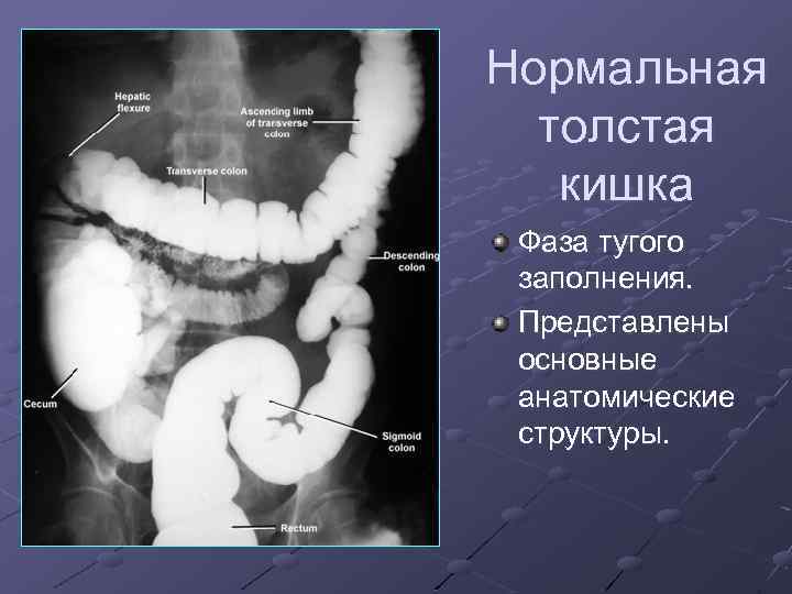 Нормальная толстая кишка Фаза тугого заполнения. Представлены основные анатомические структуры. 