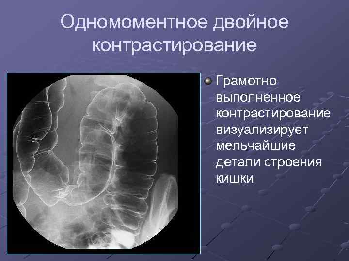 Одномоментное двойное контрастирование Грамотно выполненное контрастирование визуализирует мельчайшие детали строения кишки 