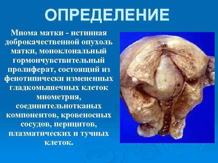   ОПРЕДЕЛЕНИЕ  Миома матки - истинная доброкачественной опухоль  матки, моноклональный