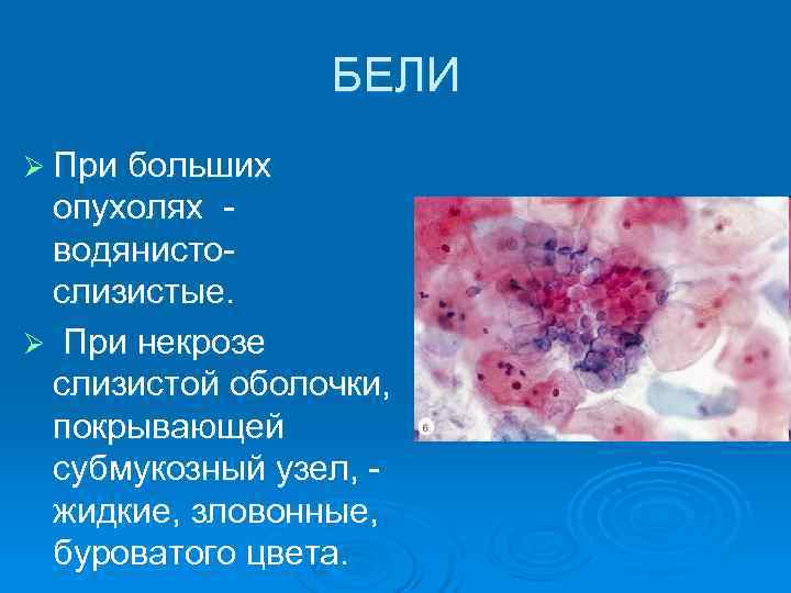     БЕЛИ Ø При больших опухолях - водянисто- слизистые. Ø При