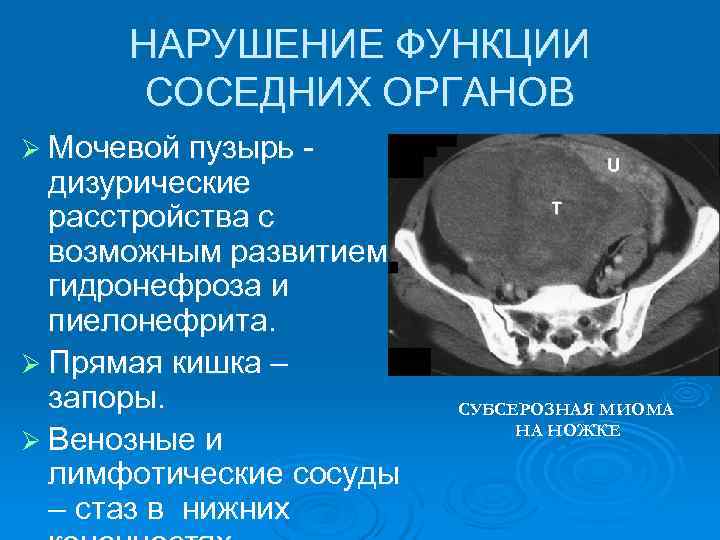  НАРУШЕНИЕ ФУНКЦИИ  СОСЕДНИХ ОРГАНОВ Ø Мочевой пузырь -  дизурические  расстройства