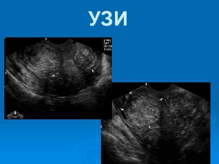 УЗИ 