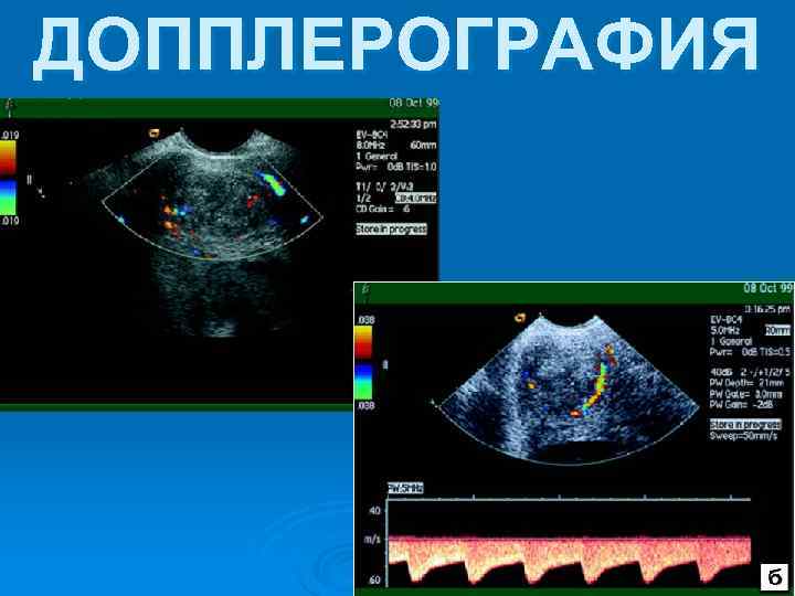 ДОППЛЕРОГРАФИЯ 