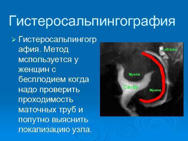 Гистеросальпингография Ø Гистеросальпингогр афия. Метод мспользуется у женщин с бесплодием когда надо проверить проходимость