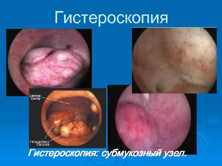  Гистероскопия: субмукозный узел. 