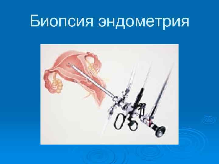 Биопсия эндометрия 