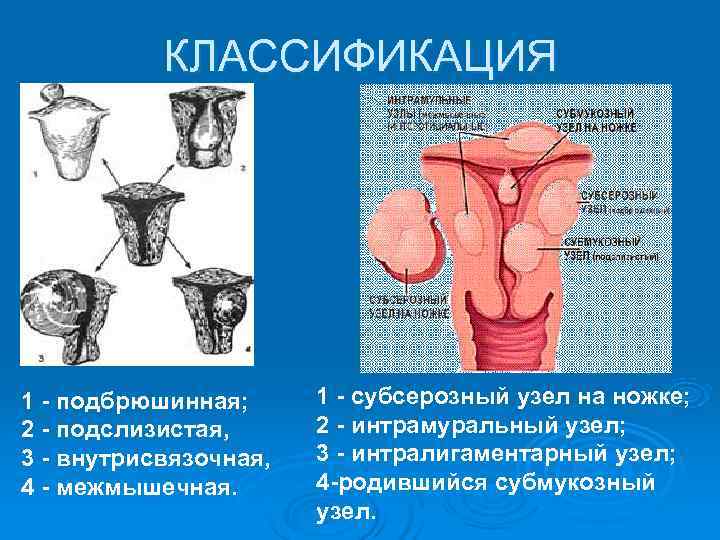   КЛАССИФИКАЦИЯ 1 - подбрюшинная;  1 - субсерозный узел на ножке; 2