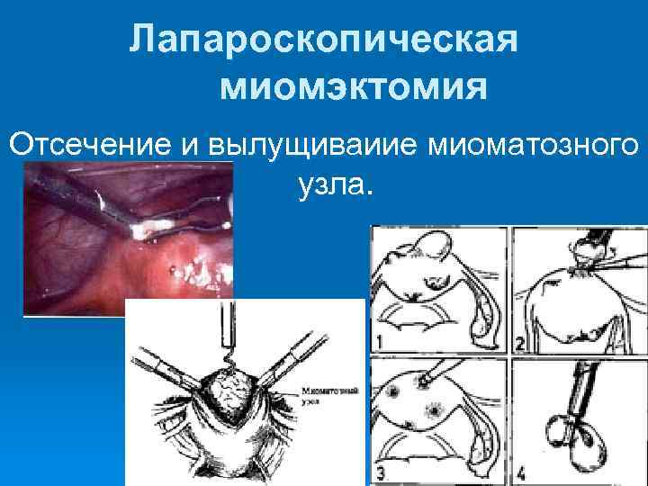  Лапароскопическая  миомэктомия Отсечение и вылущиваиие миоматозного   узла. 