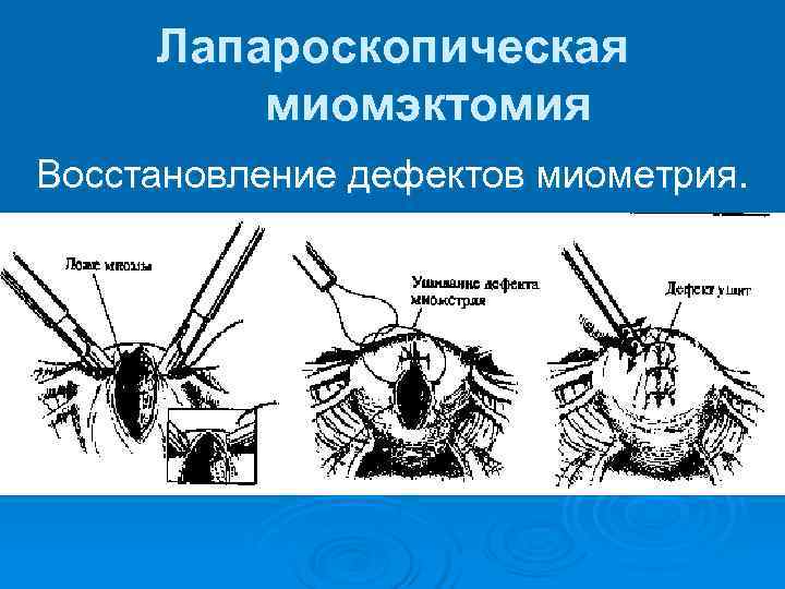  Лапароскопическая   миомэктомия Восстановление дефектов миометрия. 