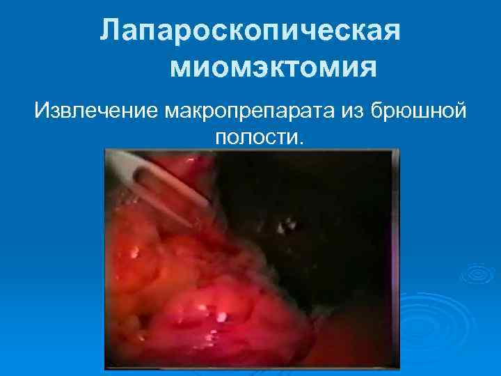  Лапароскопическая   миомэктомия Извлечение макропрепарата из брюшной    полости. 