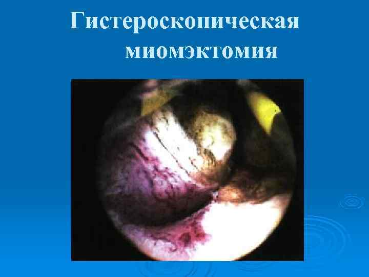 Гистероскопическая миомэктомия 