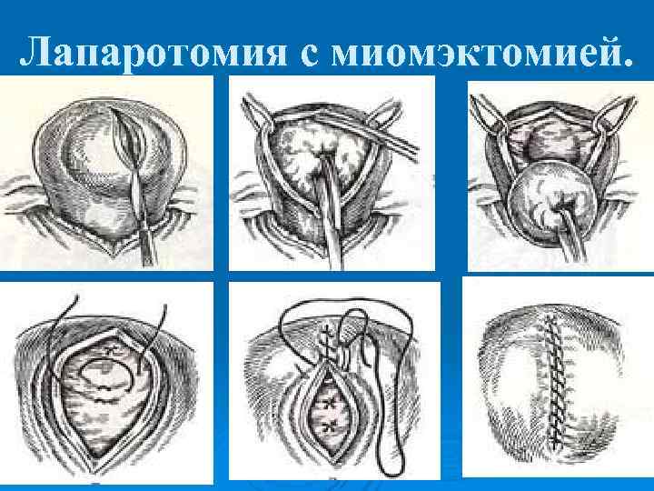 Лапаротомия с миомэктомией. 