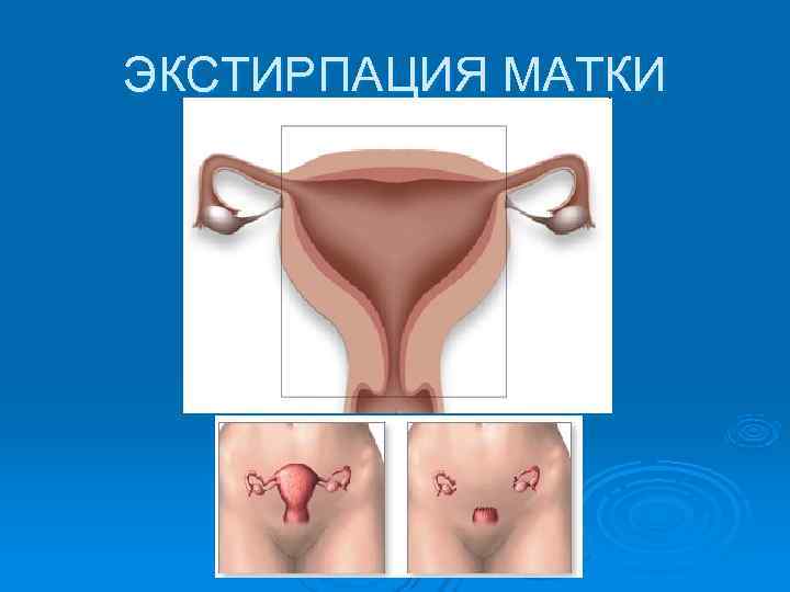 ЭКСТИРПАЦИЯ МАТКИ 