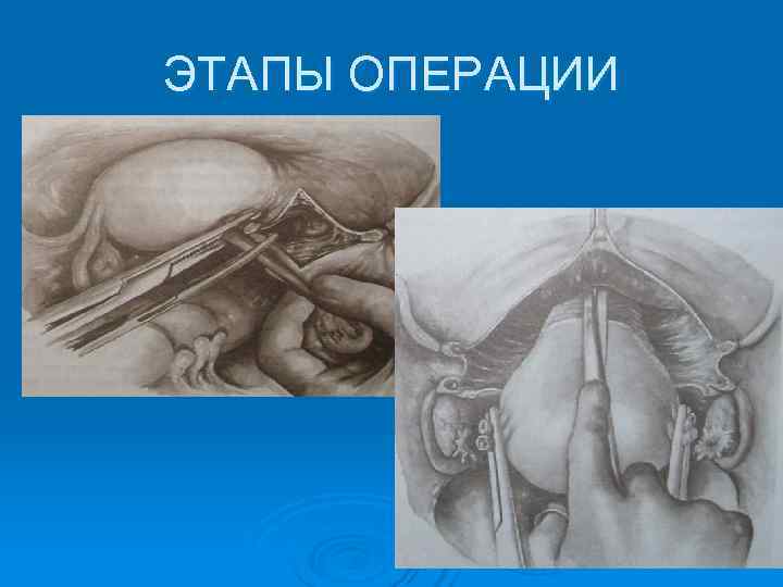 ЭТАПЫ ОПЕРАЦИИ 