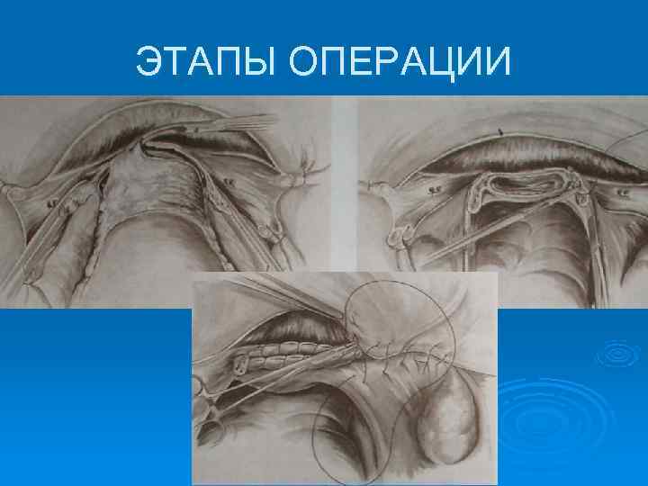 ЭТАПЫ ОПЕРАЦИИ 