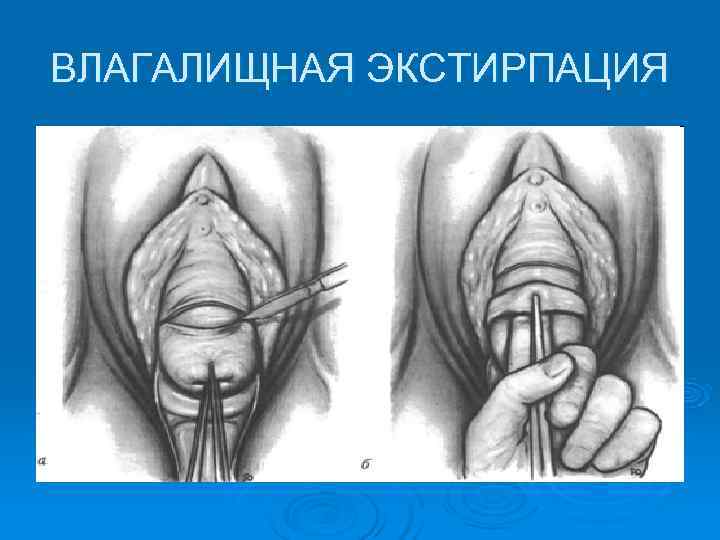 ВЛАГАЛИЩНАЯ ЭКСТИРПАЦИЯ 