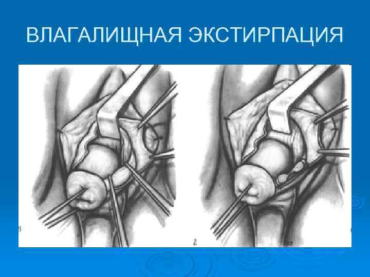 ВЛАГАЛИЩНАЯ ЭКСТИРПАЦИЯ 