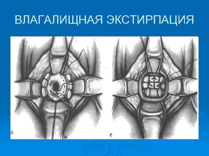 Экстирпация матки