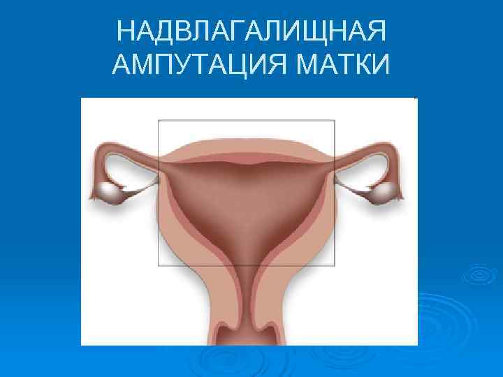 НАДВЛАГАЛИЩНАЯ АМПУТАЦИЯ МАТКИ 