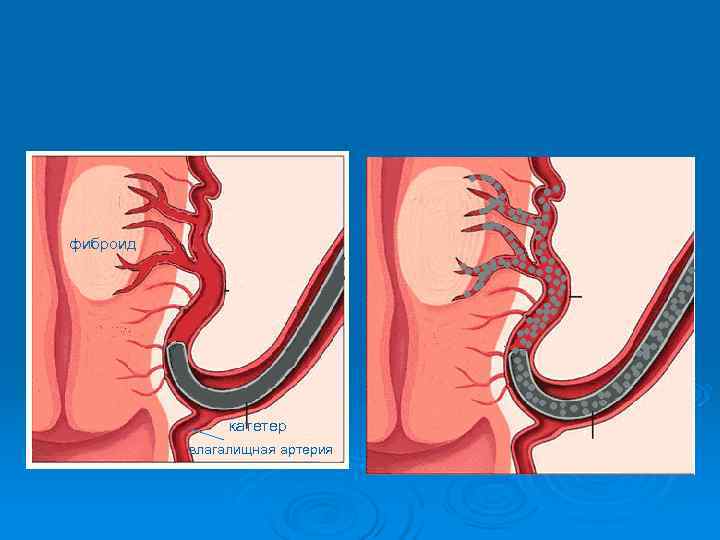 фиброид    катетер  влагалищная артерия 
